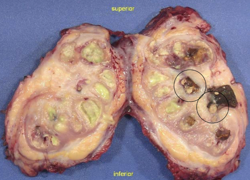 <p>pus, scarring, stones</p>