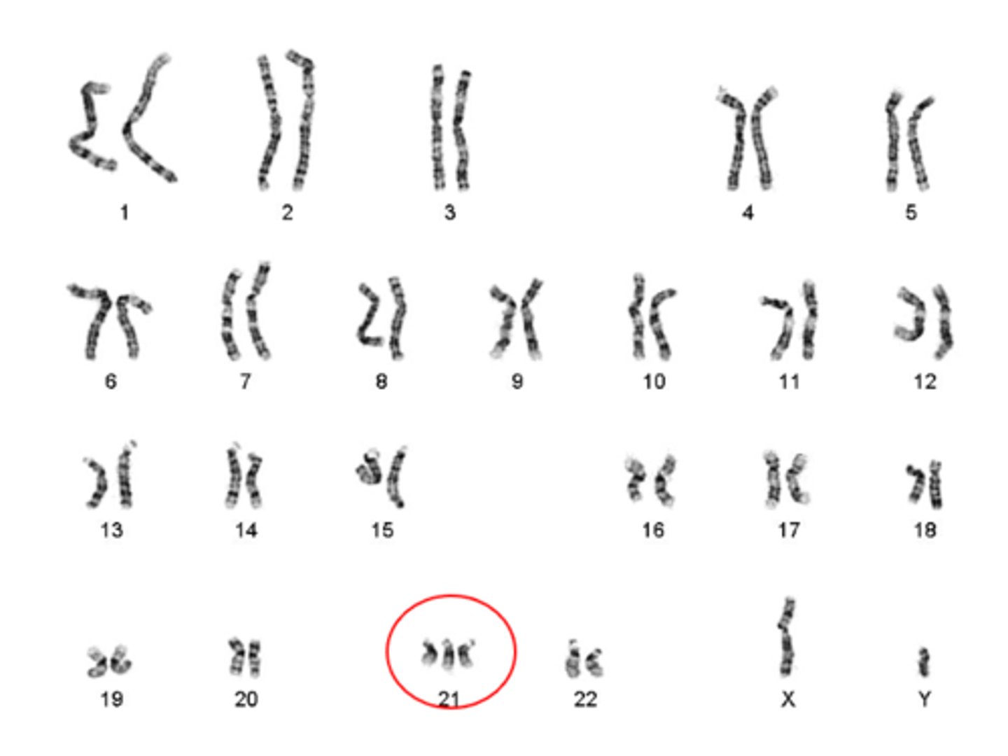 <p>based on the karyotype, identify the genetic disorder:</p>