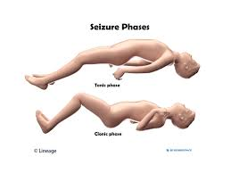 <p><strong>A 26-year-old female is resting after a one-minute episode during which she lost</strong></p><p><strong>consciousness while her muscles contracted and extremities extended. This was</strong></p><p><strong>followed by rhythmic contraction and relaxation of her extremities. On regaining</strong></p><p><strong>consciousness, she found herself to have been incontinent of urine. What has the woman</strong></p><p><strong>most likely experienced?</strong></p><p>A) A myoclonic seizure</p><p>B) A tonic-clonic seizure</p><p>C) An absence seizure</p><p>D) A complex partial seizure</p>