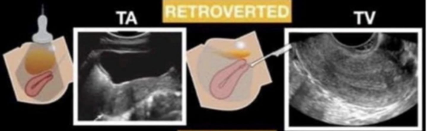 <p>the cervix forms an posterior angle of greater than 90 degrees to the vaginal canal</p>