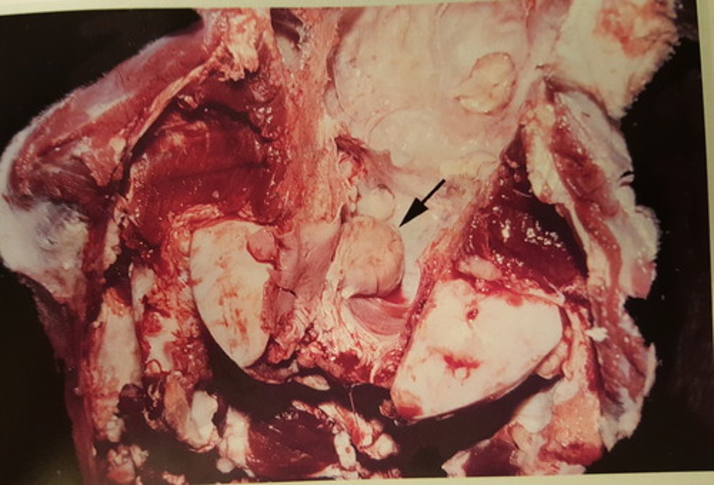 <p>Hjerne fra okse. Patoanatomisk diagnose?</p>