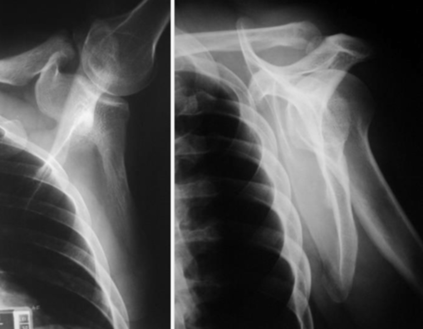 <p>In AP radiological projections, the scapula overlaps with the ribs and thoracic cage, requiring the arm to be raised to decrease overlap.</p>