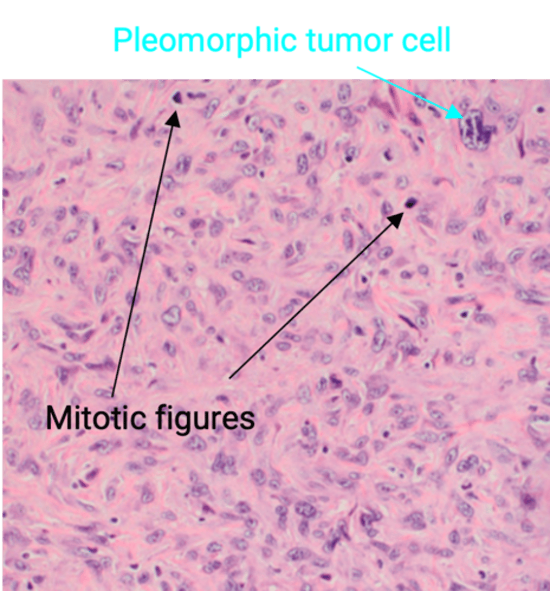 <p>Define Condition:</p><p>Undifferentiated malignant tumor of thyroid follicular epithelium</p><p>-Hx:</p><p>&gt; A/w TP53 mutation</p><p>&gt; Mean Age = 65 y/o</p><p>&gt; Arises from well-differentiated PTC or FTC (or de novo)</p><p>-Path/Sx/PE: VERY AGGRESSIVE (rapidly invades/compresses local tissue)</p><p>&gt; Trachea = Dyspnea</p><p>&gt; Esophagus = Dysphagia</p><p>&gt; RLN = Hoarseness</p><p>-Dx:</p><p>&gt; Micro = Anaplastic Cells (large, pleomorphic tumors cells)</p><p>-Prog: POOR PROGNOSIS (mortality rate ~ 100% w/n less than 1 yr) d/t aggressive local growth and compromising vital structures in neck</p>