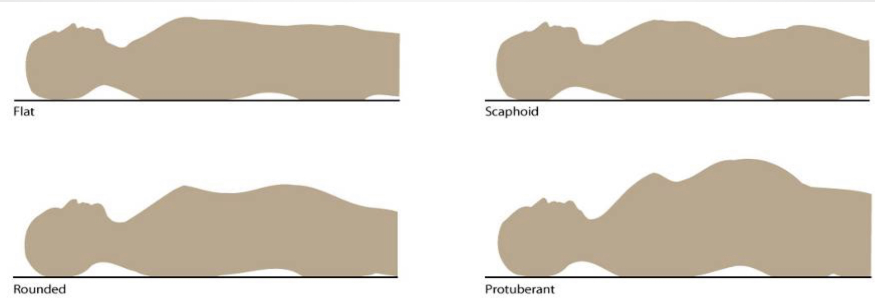Flat
Scaphoid
Rounded
Protuberant