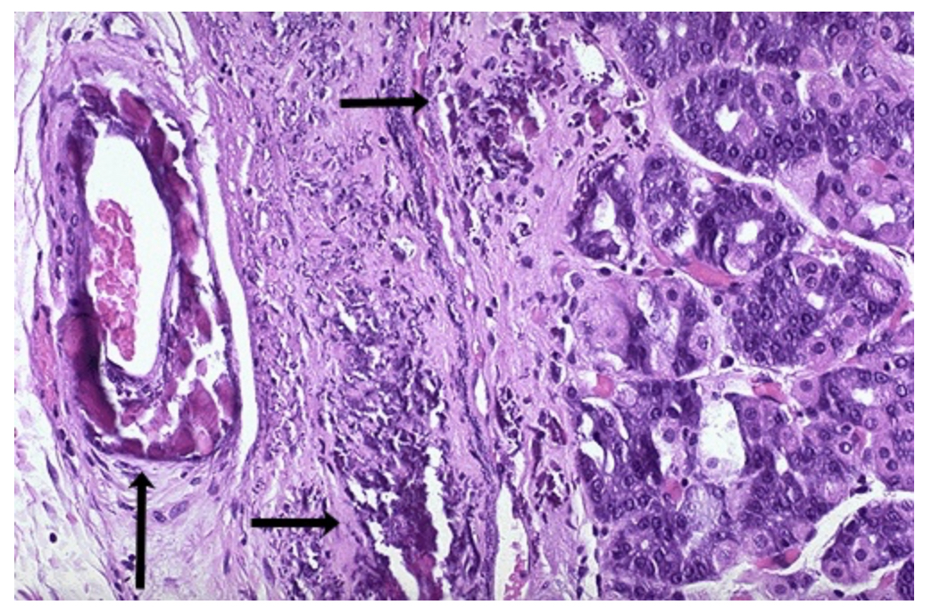 <ol><li><p>What are these bluish-purple deposits found in the submucosa, the artery, and the stomach wall?</p></li><li><p>What is the condition called?</p></li></ol><p></p>