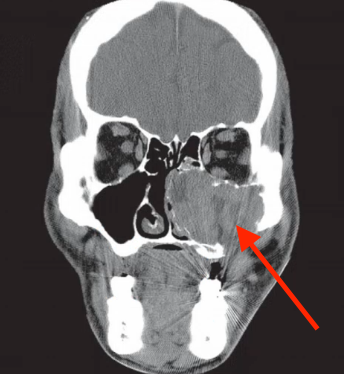 <p>likely diagnosis of this AGGRESIVE lesion in maxilla </p>