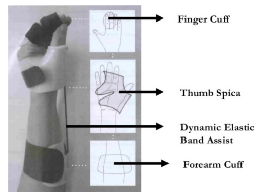 <p><strong>Tenodesis splint</strong></p><p><strong>Function:</strong></p><ul><li><p>To train tenodesis grasp.</p></li><li><p>To promote a strong tripod pinch with wrist extension.</p></li><li><p>Allows finger opening with wrist flexion.</p></li></ul><p><strong>Indications:</strong></p><ul><li><p>C6 quadriplegia with Grade 3 strength of wrist extensors</p></li></ul><p></p>