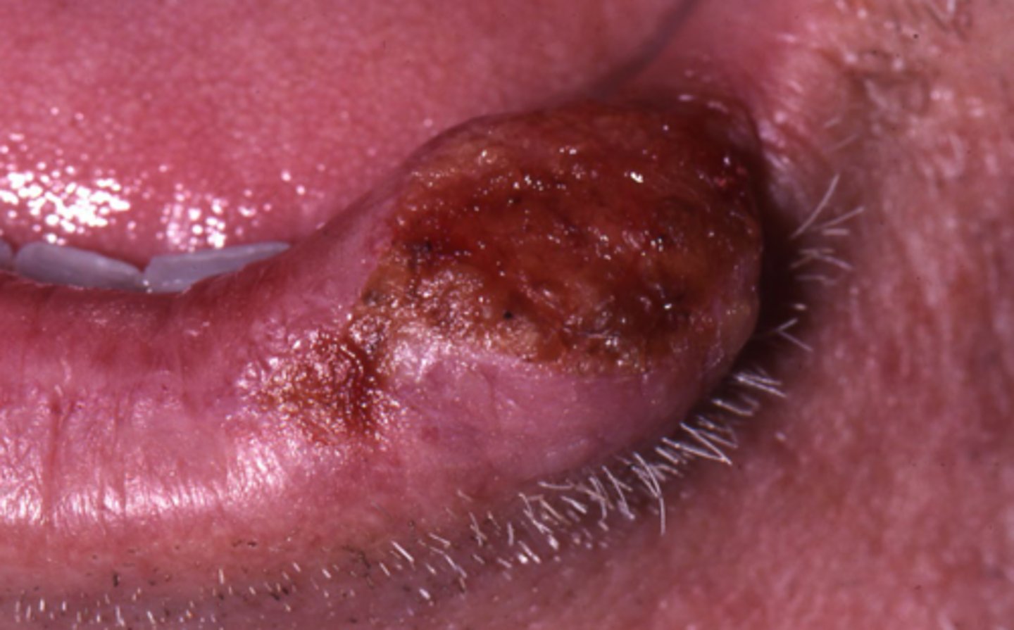 <p>75-80% from tobacco w/ or w/out alcohol</p><p>also sun and HPV</p>