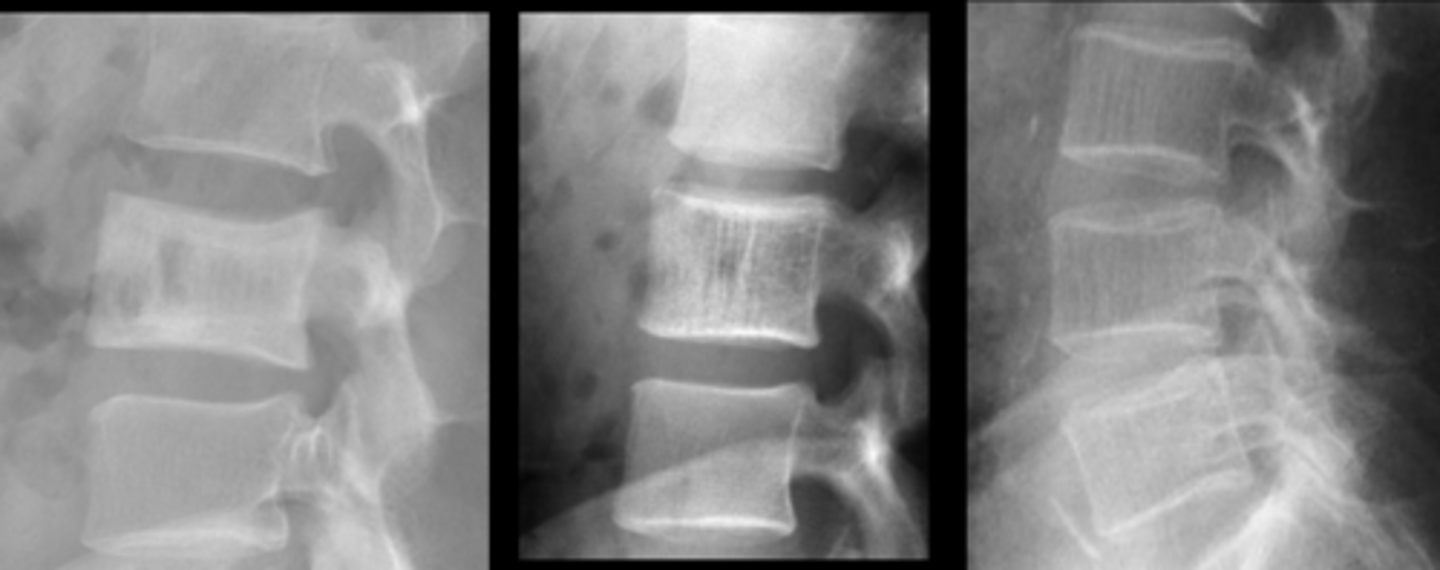 <p>Complete the DDx for vertebral hemangioma</p>