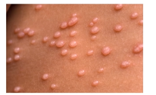 <p>small, central depression on papules </p>