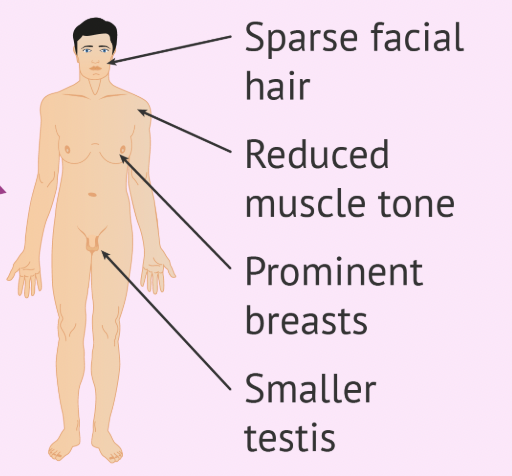 <p>Klinefelter Syndrome </p>