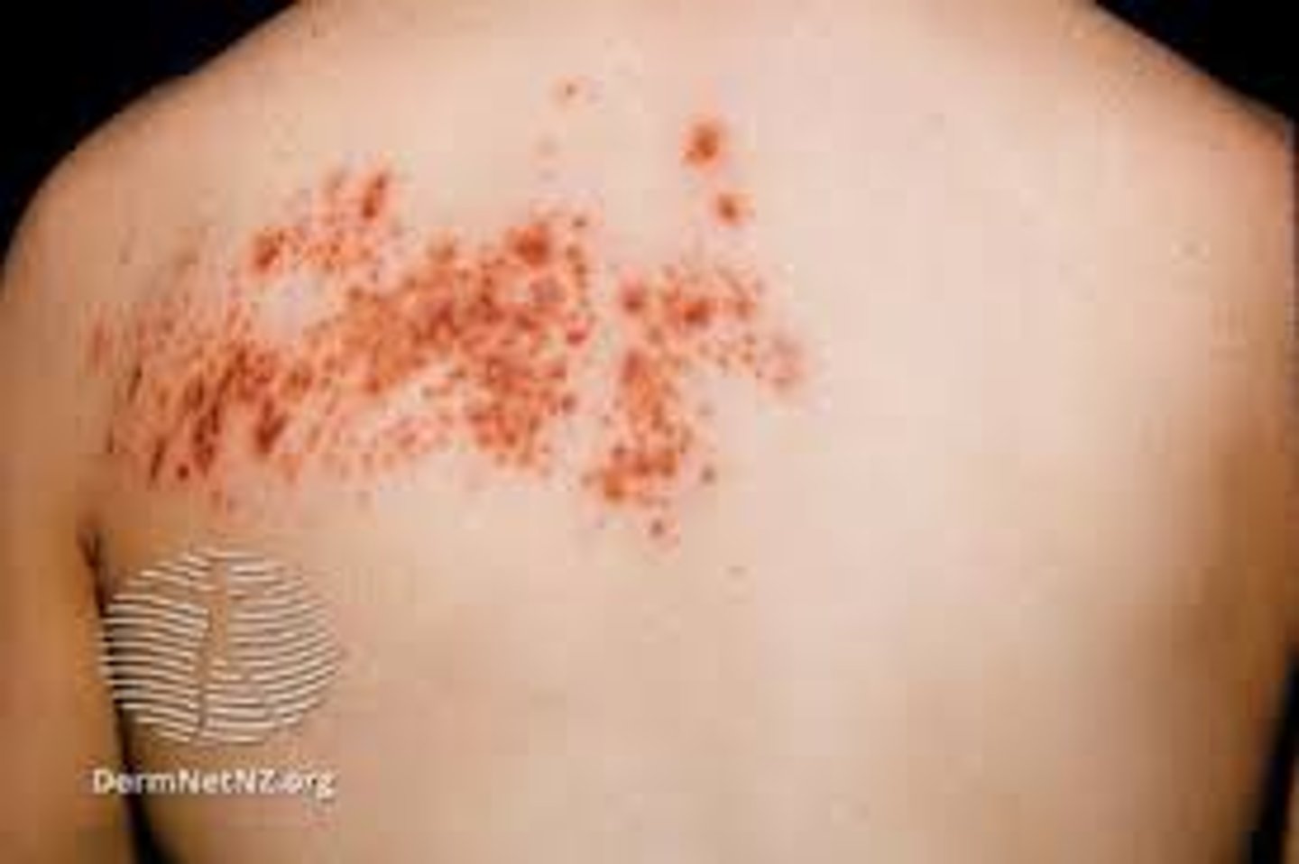 <p>name this skin pathology</p>