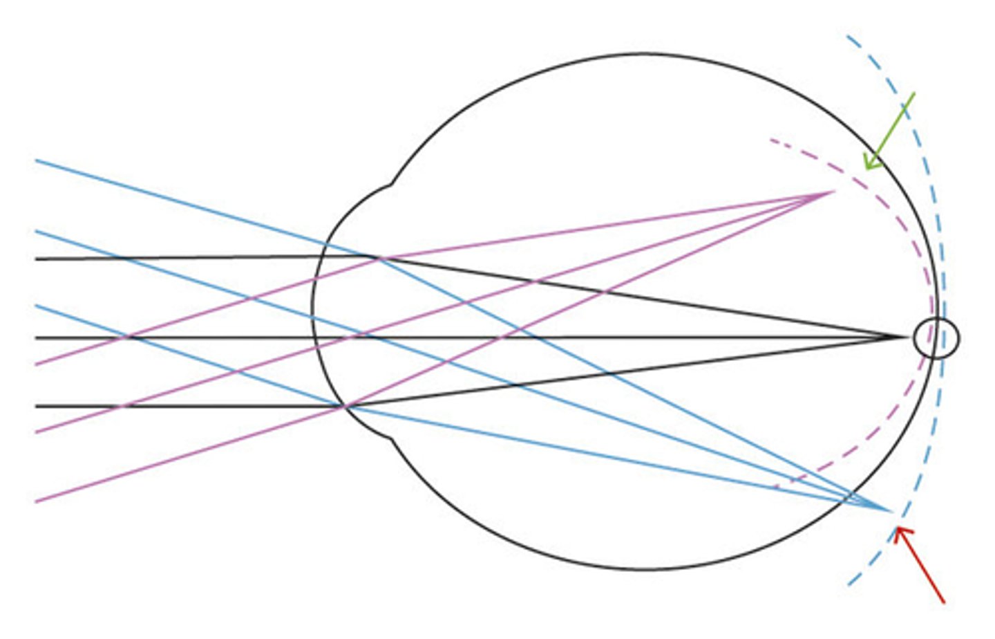 <p>image is in front of the retina - created by positive lenses</p><p>image - purple lines</p>