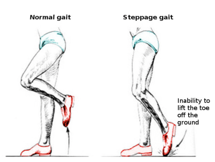 <p>walking with a high step, hard to lift food (looks like they’re climbing stairs), foot slaps ground with each step </p>