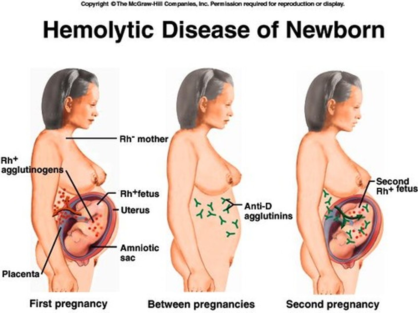 <p>Condition from Rh- mother with Rh+ fetus.</p>