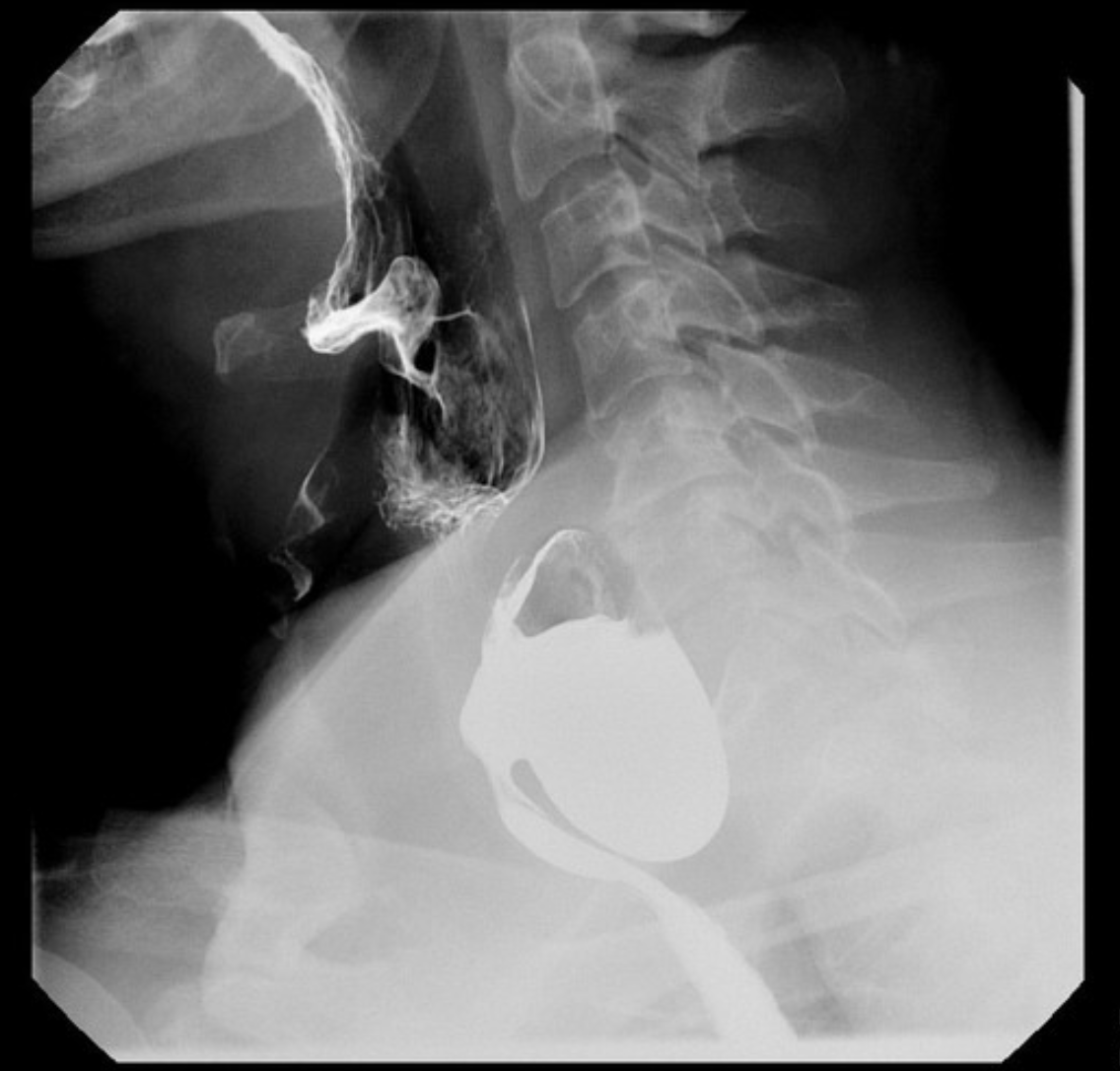 <p>58 y/o male presents to the the ER for dysphagia that “feels like choking.” He also notes that he often throws up at night and has trouble sleeping due to a choking sensation. On a physical exam you note halitosis and a palpable mass in the neck. What is your treatment of choice?</p>