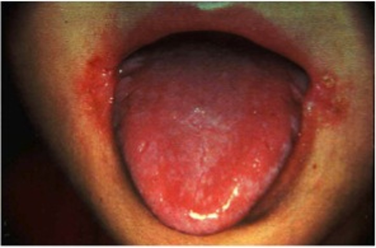 <p>Sore throat, swollen mucous membranes, skin rash</p>