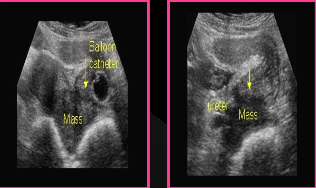 <p>Cervical carcinoma typically appears in ________ women</p>