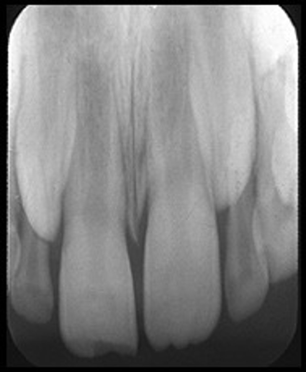 <p>Long distorted teeth. Too little vertical angulation.</p>