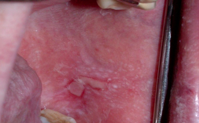 <p>What is an oral mucosal cinnamon reaction?</p>