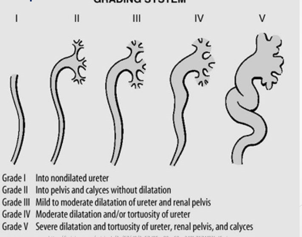 <ul><li><p><span><strong>Grade I</strong>: Into nondilated ureter.</span></p></li><li><p><span><strong>Grade II</strong>: Into pelvis and calyces without dilatation.</span></p></li><li><p><span><strong>Grade III</strong>: Mild to moderate dilatation of ureter and renal pelvis.</span></p></li><li><p><span><strong>Grade IV</strong>: Moderate dilatation or tortuosity of ureter.</span></p></li><li><p><span><strong>Grade V</strong>: Severe dilatation and tortuosity of ureter, renal pelvis, and calyces.</span></p></li></ul><p></p>
