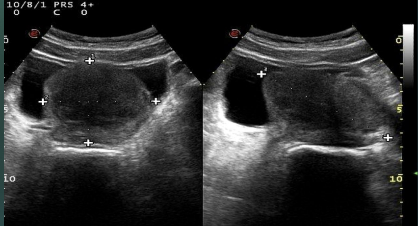 <p>What is the image showing? Give a diagnosis.</p>