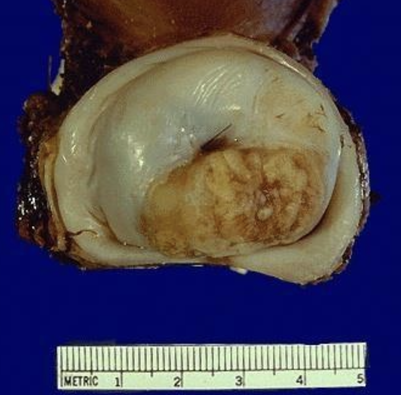 <p>Identify the <strong>organ</strong> and the <strong>diagnosis</strong> in this format: <em>diagnosis, organ</em></p>