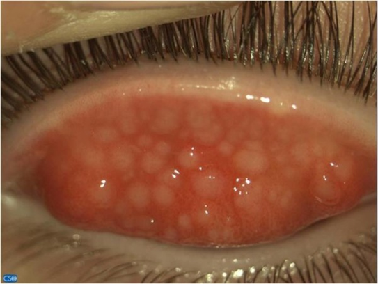 follicles in the superior tarsal conjunctiva