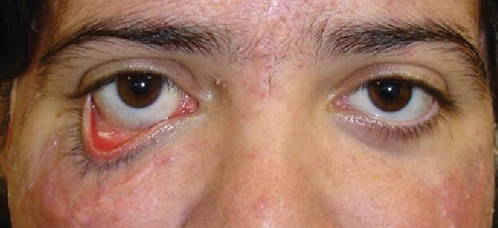 <p>What type of <strong>ectropion</strong> is caused by the <strong><mark data-color="yellow" style="background-color: yellow; color: inherit">shortening of the anterior lamella</mark></strong>, trauma, scarring, chronic sun exposure, or inflammation?</p>