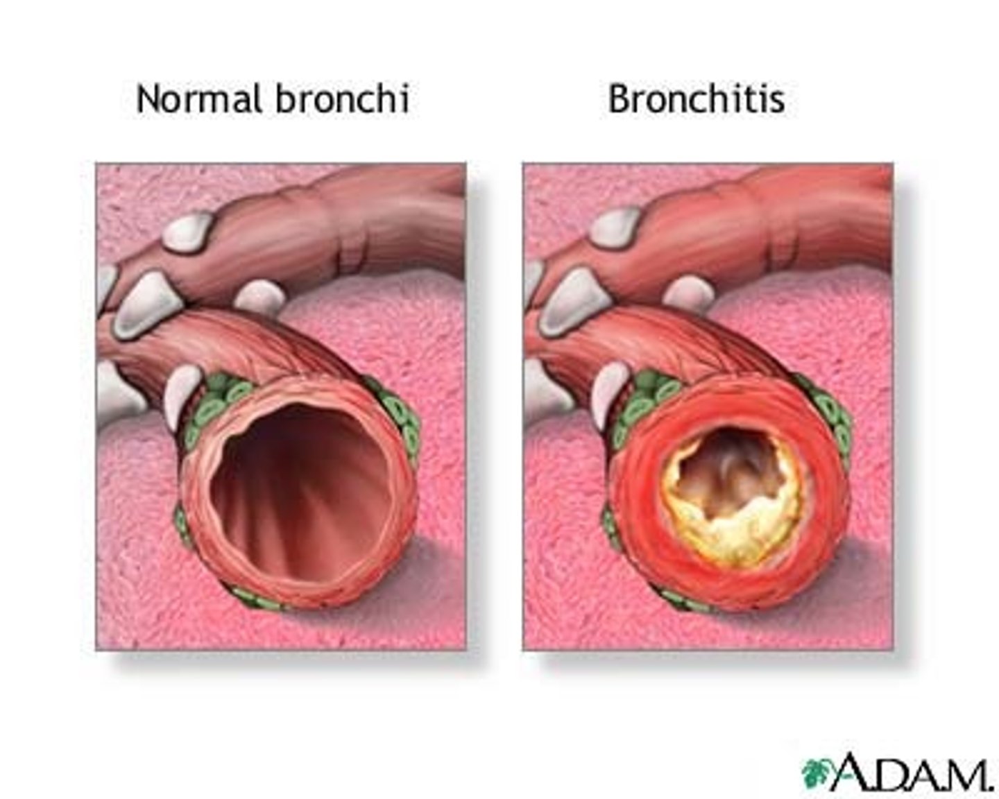 <p>inflammation of the bronchi</p>