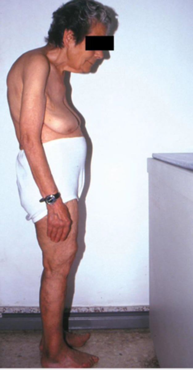 <p>- shorter spine: cervical kyphosis, lumbar lordosis</p><p>- belly falls forward</p><p>- porotic leatherwood</p><p>- Christmas tree sign</p>