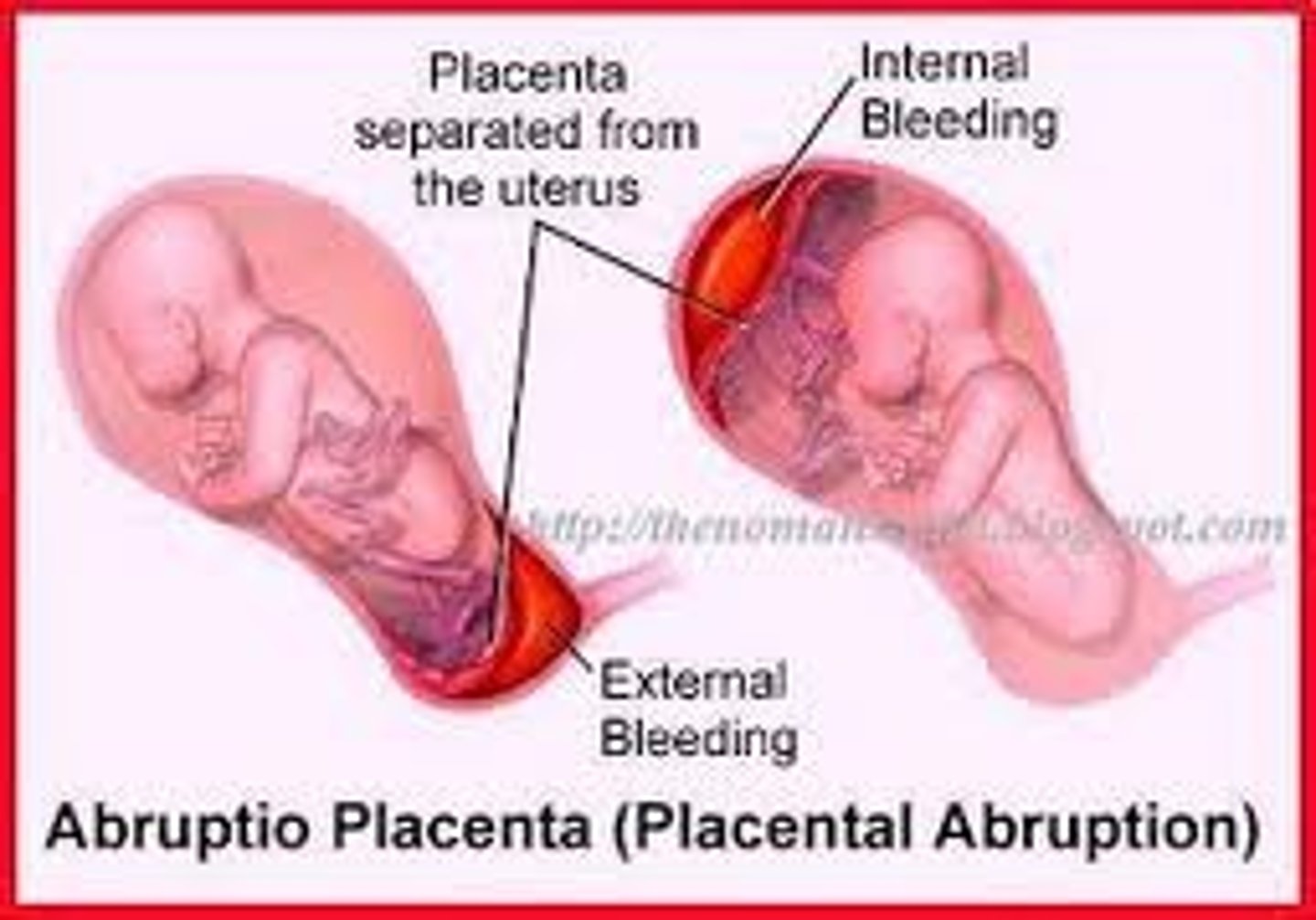 <p>placenta separates prematurely from wall of uterus</p><p>-most commonly caused by hypertension or trauma</p>