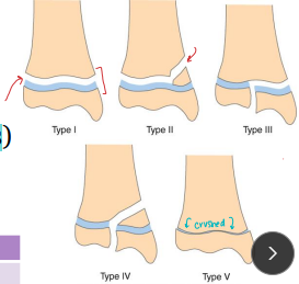 <p>Physeal fractures</p>
