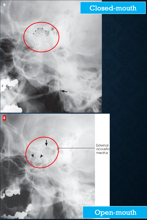 <ul><li><p>TMJ with mouth open and closed</p></li><li><p>both sides done for comparison</p></li><li><p>TMJ anterior to EAM</p></li><li><p>closed mouth: condyle in mandibular fossa</p></li><li><p>open mouth: condule inferior to the articular tubercle</p></li></ul><p></p>
