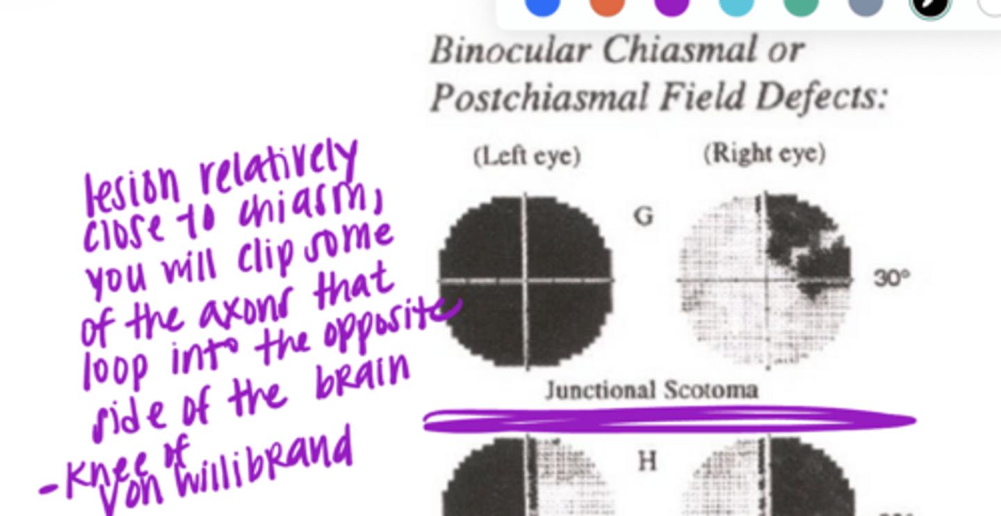<p>Why is the OD affected in this VF pictured?</p>