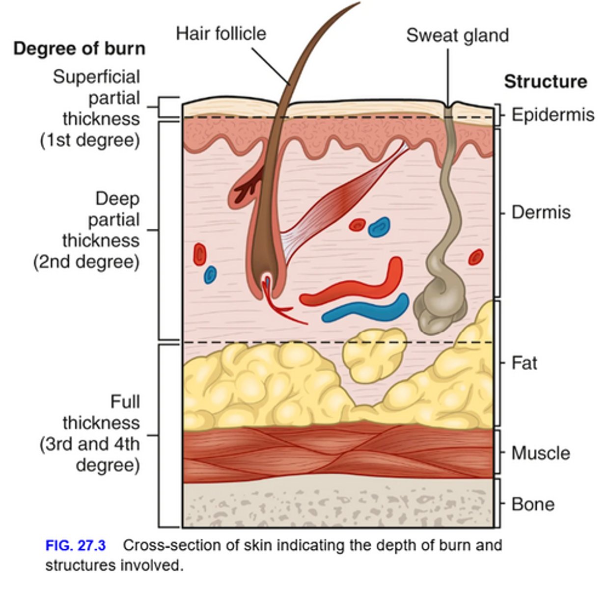 <p>- Burns continue to be defined by degrees: first-, second-, third-, and fourth-degree</p><p>- The ABA recommends a more precise definition, classifying them according to depth of skin destruction: partial-thickness burn and full-thickness burn</p>