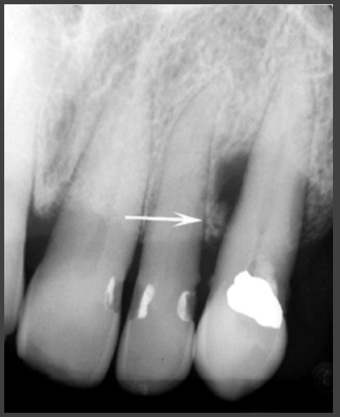 <p><strong>Periodontal abscess</strong></p><ul><li><p>Rapidly progressing destructive lesion</p></li><li><p>Usually originates in deep soft tissue periodontal pocket</p><ul><li><p>Occurs when coronal portion of pocket becomes obstructed</p></li></ul></li><li><p>Pain, swelling, sometimes draining fistula</p></li><li><p>May not be visible changes on imaging if acute</p></li><li><p>Radiolucent region develops if persists</p><ul><li><p>Round area often superimposed over root</p></li><li><p>Loss of lamina dura on involved surface</p></li><li><p>Bridge of bone may be visible over coronal aspect separating it from crest</p></li></ul></li><li><p>After treatment some of lost bone may regenerate</p></li></ul><p></p>
