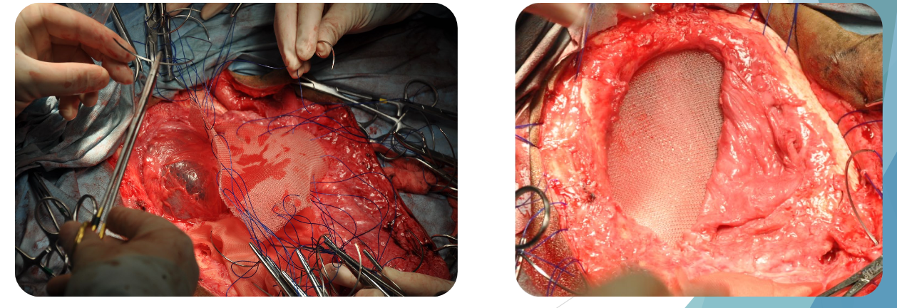 <p>polyglactin 910 - Vicryl</p><p>Polypropylene - Prolene</p>