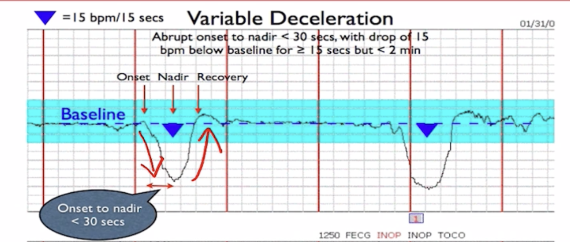 <p>-High levels of Concern</p><p>-Abrupt decrease and then return to baseline</p><p>-Unpredictable shape</p><p>-Caused by cord compression</p>