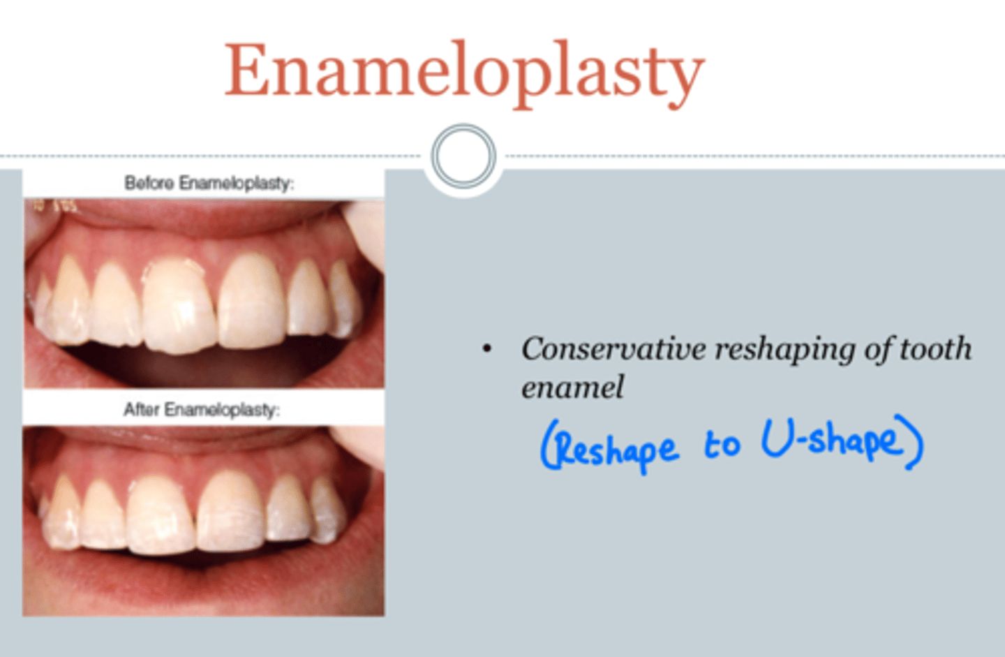 <p>reshaping of a tooth/removin a small amount of the enamel by grinding</p>