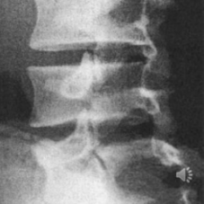 <p>defect at pars interarticularis</p>