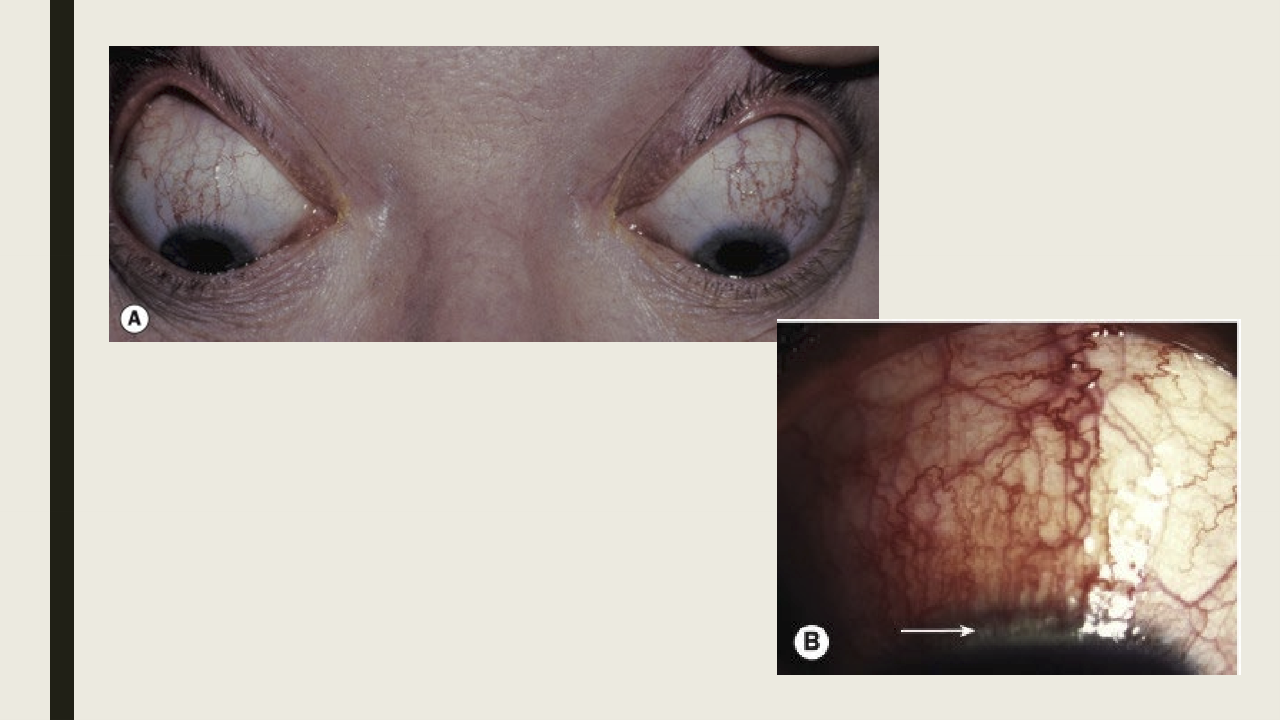 <ul><li><p>Similar to dry eye treatment: artificial tears, topical anti-inflammatory medication, topcial cyclosporine, concurrent lid disease</p></li><li><p>Bandage contact lens </p></li></ul><p></p>