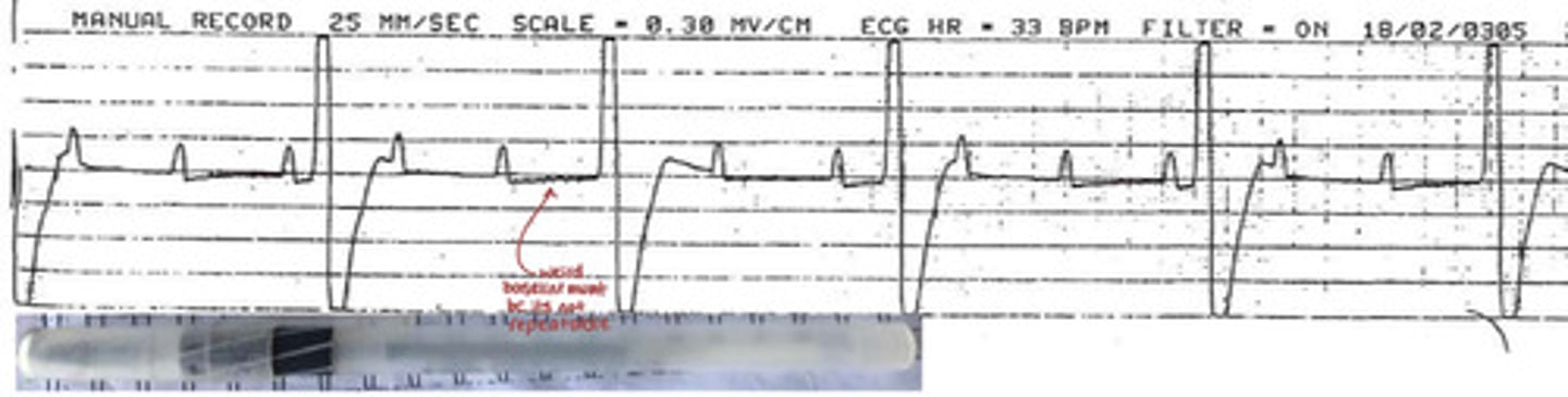 <p>What arrhythmia is this?</p>