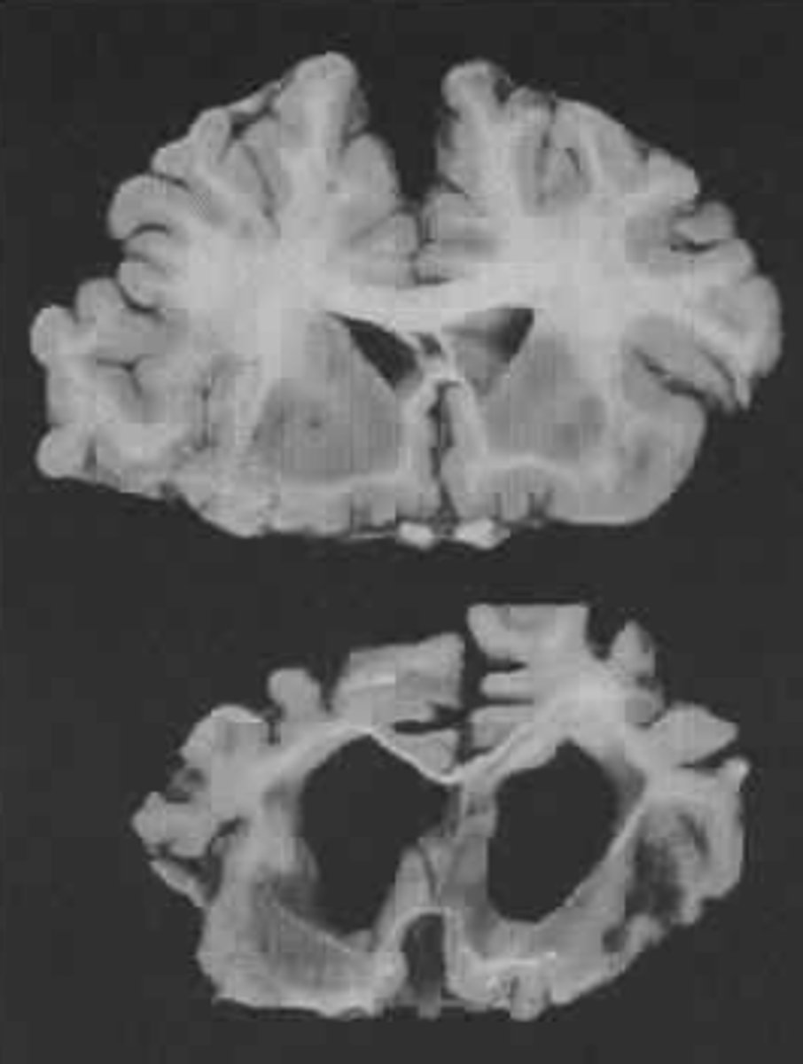 <p>- Can't find the right words (e.g. word salad)</p><p>- Vague language</p><p>- Single phrases</p><p>- Use of sounds and vocalizations</p><p>- Unable to make needs known</p>