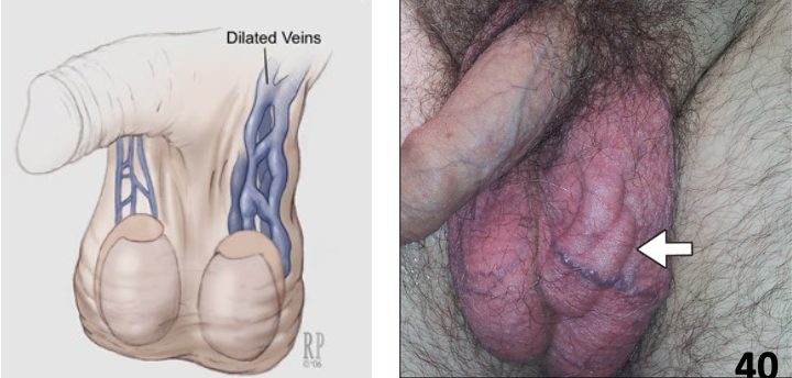 <p>treatment of Varicocele</p>