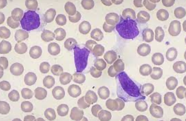 <p>What type of smear cell and what conditions is it seen in</p>