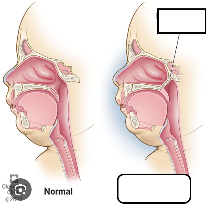 <p>Rare congenital anamoly blocking posterior nostrils on one or both sides </p>