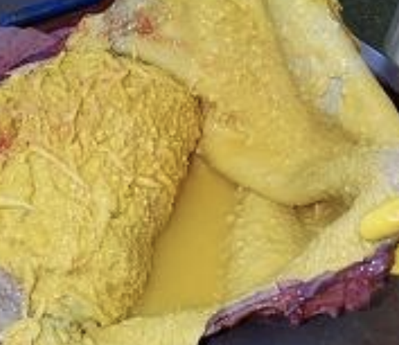 <p>What type of infection response is due to hardware disease, in which there is a distended pericardial sac with yellow-white pus, a thick fibrous pericardium, and a fetid odor? Death or chronic heart failure can occur.</p>