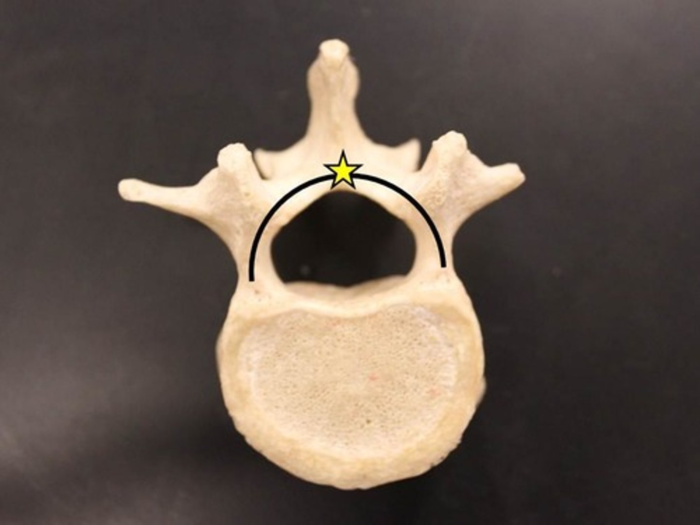 <p>composed of pedicles, laminae, and a spinous process, it represents the junction of all posterior extensions from the vertebral body</p>