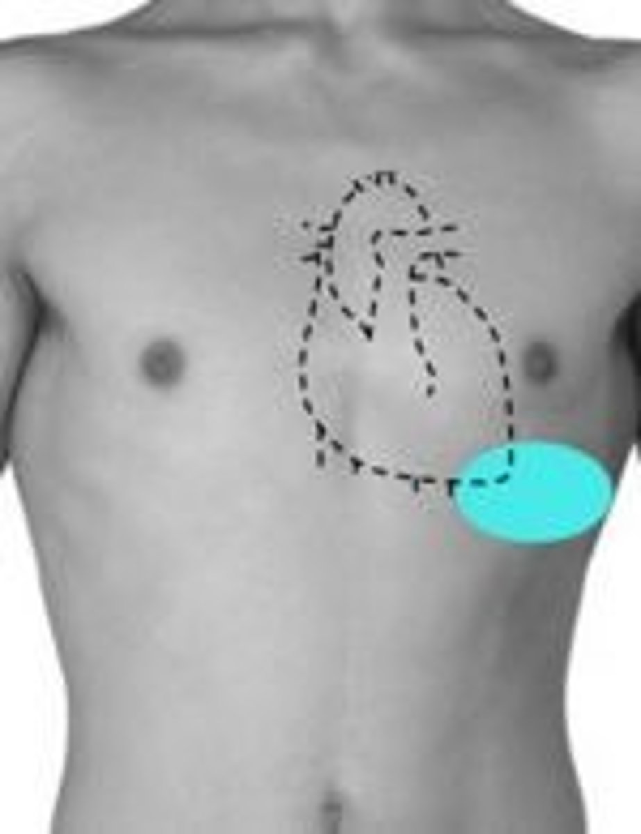 <p>5th ICS, left midclavicular line</p>